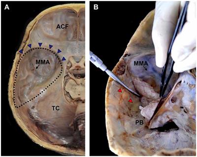 Macroscopic Innervation of the Dura Mater Covering the Middle Cranial Fossa in Humans Correlated to Neurovascular Headache